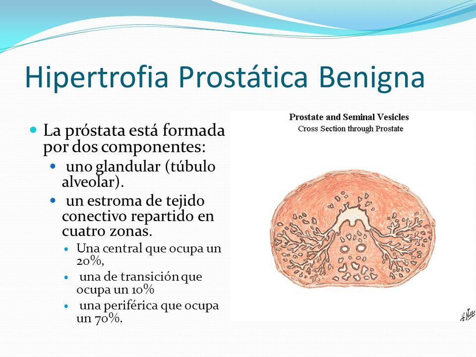 hipertrofia benigna de próstata que estas